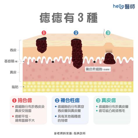 手臂痣長毛代表什麼|痣形成的原因？痣長毛、痣變多變大是痣病變？5招判。